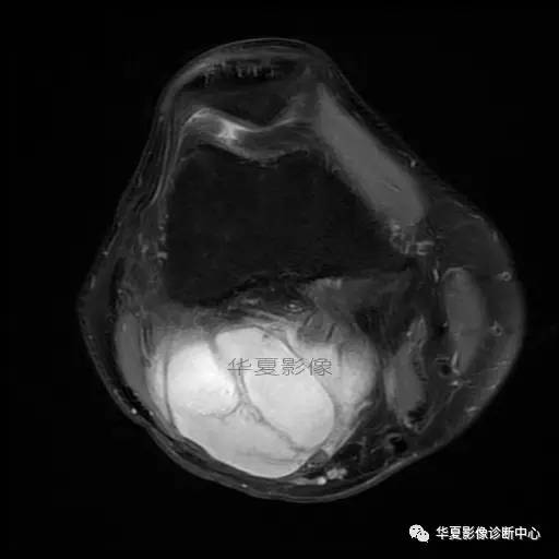 【病例】大腿脂肪肉瘤的影像分析 【病例】大腿脂肪肉瘤的影像分析
