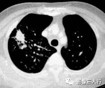 “毛刺征” 的影像表现与临床意义 “毛刺征” 的影像表现与临床意义