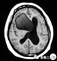 【病例】右额颞部高密度表皮样囊肿1例CT及MR影像分析