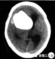 【病例】右额颞部高密度表皮样囊肿1例CT及MR影像分析