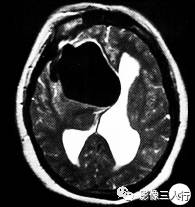 【病例】右额颞部高密度表皮样囊肿1例CT及MR影像分析
