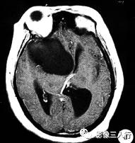 【病例】右额颞部高密度表皮样囊肿1例CT及MR影像分析
