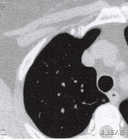 “磨玻璃征” 的影像表现与临床意义 “磨玻璃征” 的影像表现与临床意义