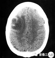 【病例】脱髓鞘性假瘤1例CT及MR影像分析 【病例】脱髓鞘性假瘤1例CT及MR影像分析
