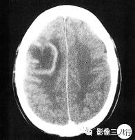 【病例】脱髓鞘性假瘤1例CT及MR影像分析 【病例】脱髓鞘性假瘤1例CT及MR影像分析