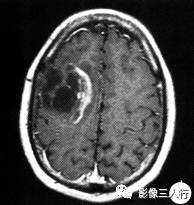 【病例】脱髓鞘性假瘤1例CT及MR影像分析