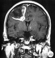 【病例】脱髓鞘性假瘤1例CT及MR影像分析 【病例】脱髓鞘性假瘤1例CT及MR影像分析