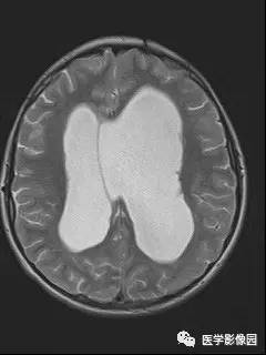 【病例】室管膜下巨细胞型星形细胞瘤1例MR影像表现