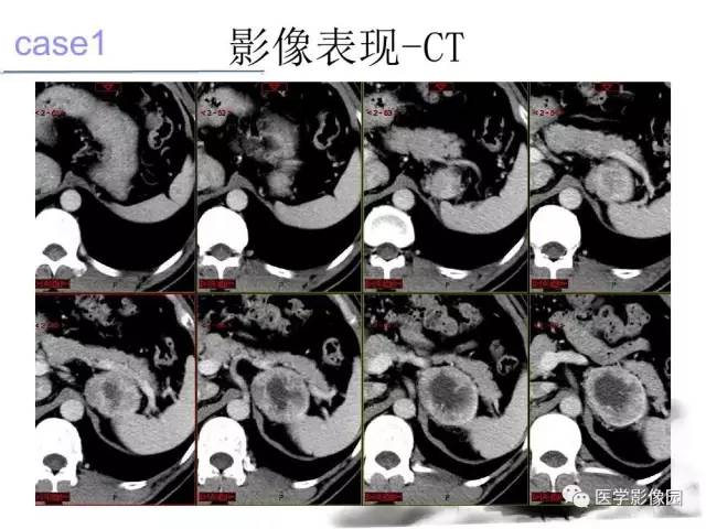 【病例】左肾上腺及腹膜后嗜铬细胞瘤1例MR