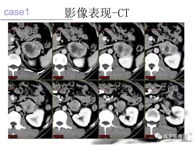 【病例】左肾上腺及腹膜后嗜铬细胞瘤1例MR
