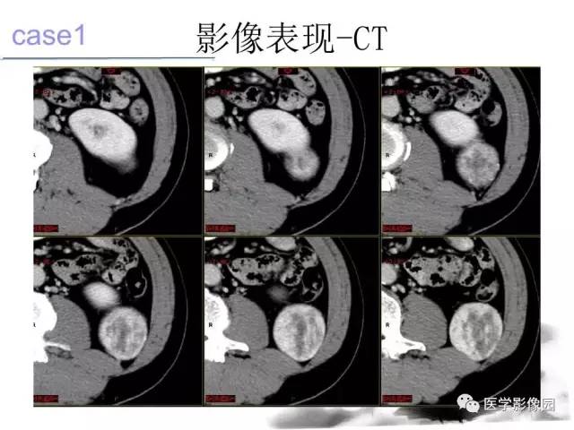 【病例】左肾上腺及腹膜后嗜铬细胞瘤1例MR