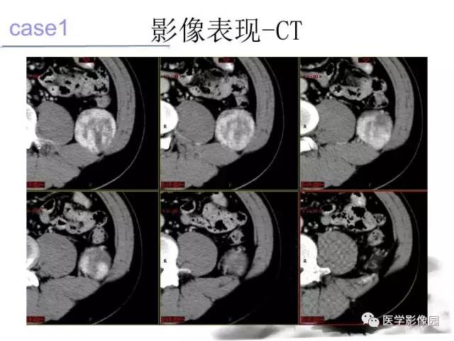 【病例】左肾上腺及腹膜后嗜铬细胞瘤1例MR