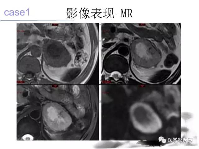 【病例】左肾上腺及腹膜后嗜铬细胞瘤1例MR