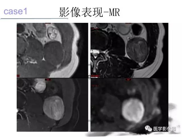 【病例】左肾上腺及腹膜后嗜铬细胞瘤1例MR