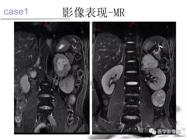 【病例】左肾上腺及腹膜后嗜铬细胞瘤1例MR