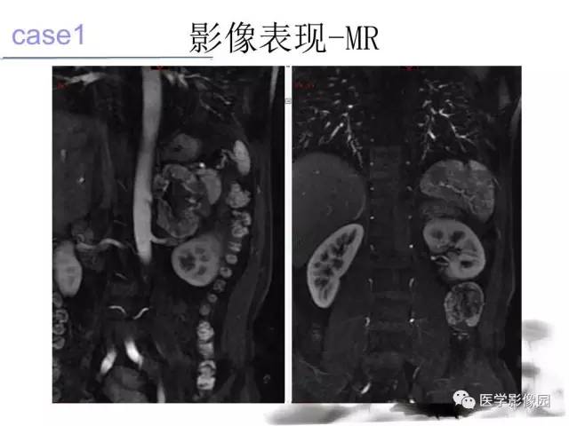 【病例】左肾上腺及腹膜后嗜铬细胞瘤1例MR