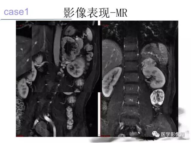 【病例】左肾上腺及腹膜后嗜铬细胞瘤1例MR