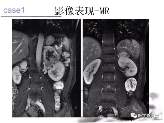 【病例】左肾上腺及腹膜后嗜铬细胞瘤1例MR