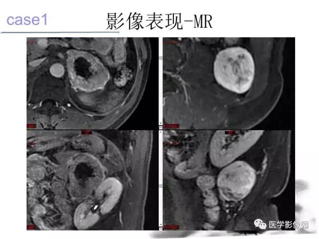 【病例】左肾上腺及腹膜后嗜铬细胞瘤1例MR