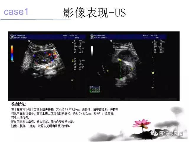 【病例】左肾上腺及腹膜后嗜铬细胞瘤1例MR