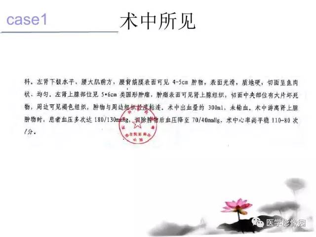【病例】左肾上腺及腹膜后嗜铬细胞瘤1例MR