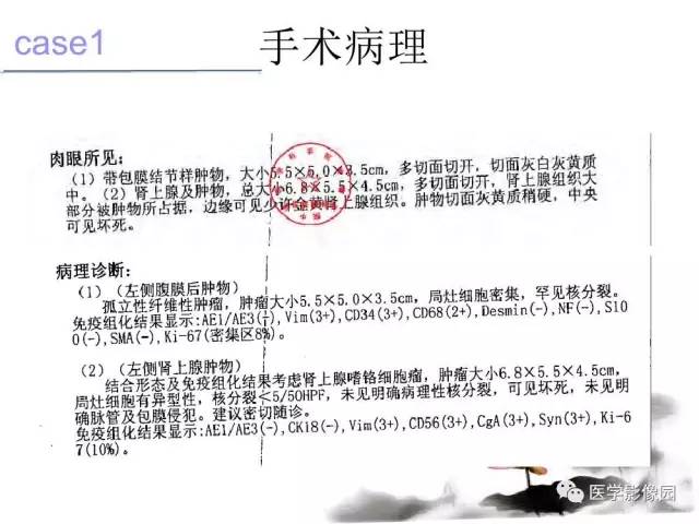 【病例】左肾上腺及腹膜后嗜铬细胞瘤1例MR