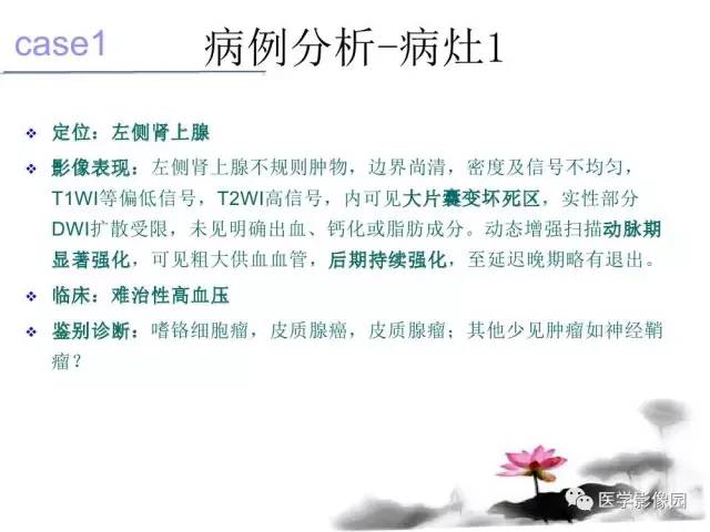 【病例】左肾上腺及腹膜后嗜铬细胞瘤1例MR