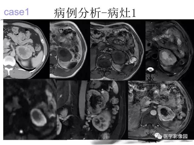 【病例】左肾上腺及腹膜后嗜铬细胞瘤1例MR