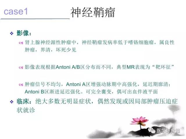 【病例】左肾上腺及腹膜后嗜铬细胞瘤1例MR