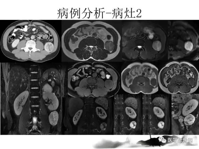 【病例】左肾上腺及腹膜后嗜铬细胞瘤1例MR