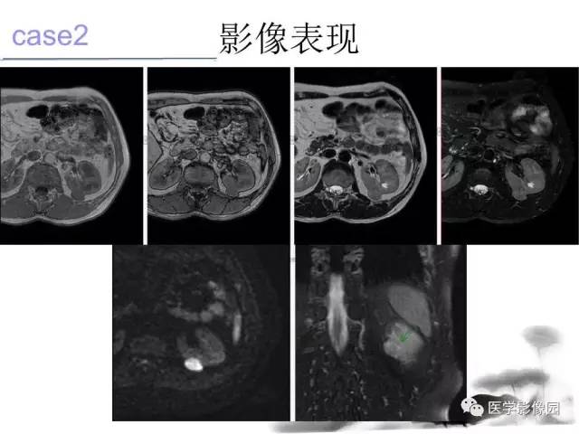 【病例】左肾嫌色细胞肾癌+透明细胞肾癌1例MR影像分析