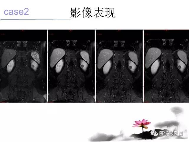 【病例】左肾嫌色细胞肾癌+透明细胞肾癌1例MR影像分析