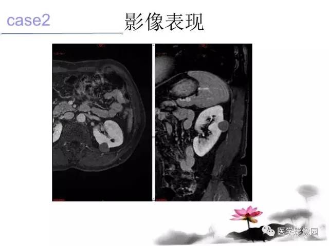 【病例】左肾嫌色细胞肾癌+透明细胞肾癌1例MR影像分析