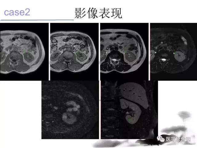 【病例】左肾嫌色细胞肾癌+透明细胞肾癌1例MR影像分析