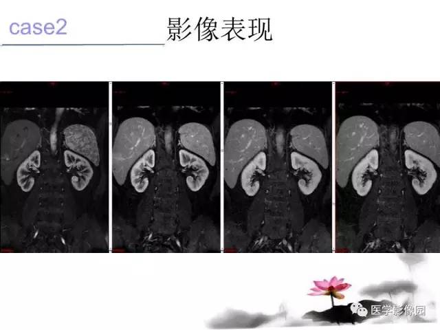 【病例】左肾嫌色细胞肾癌+透明细胞肾癌1例MR影像分析