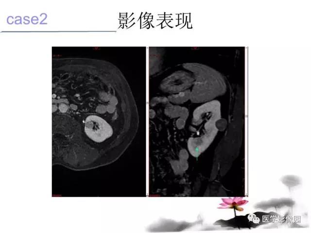 【病例】左肾嫌色细胞肾癌+透明细胞肾癌1例MR影像分析