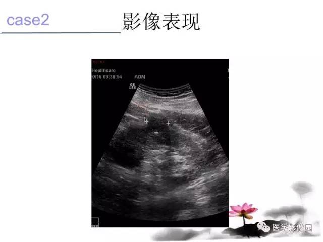 【病例】左肾嫌色细胞肾癌+透明细胞肾癌1例MR影像分析