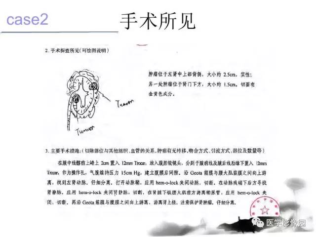 【病例】左肾嫌色细胞肾癌+透明细胞肾癌1例MR影像分析