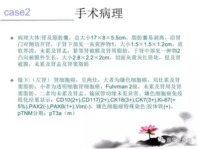 【病例】左肾嫌色细胞肾癌+透明细胞肾癌1例MR影像分析