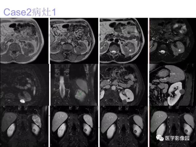 【病例】左肾嫌色细胞肾癌+透明细胞肾癌1例MR影像分析