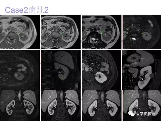 【病例】左肾嫌色细胞肾癌+透明细胞肾癌1例MR影像分析