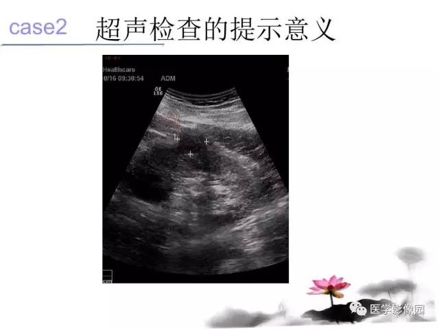 【病例】左肾嫌色细胞肾癌+透明细胞肾癌1例MR影像分析