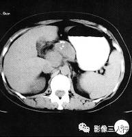 【病例】胰腺结核1例CT影像诊断分析 【病例】胰腺结核1例CT影像诊断分析