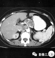 【病例】胰腺结核1例CT影像诊断分析 【病例】胰腺结核1例CT影像诊断分析