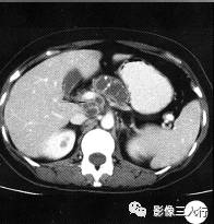 【病例】胰腺结核1例CT影像诊断分析