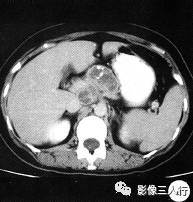 【病例】胰腺结核1例CT影像诊断分析 【病例】胰腺结核1例CT影像诊断分析