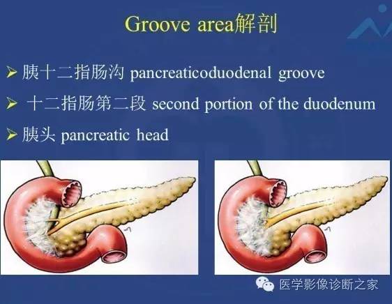 【PPT】沟区胰腺炎CT、MRI及临床相关性