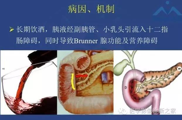 【PPT】沟区胰腺炎CT、MRI及临床相关性