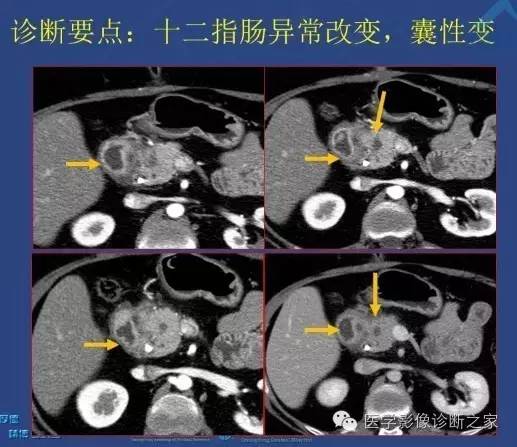 【PPT】沟区胰腺炎CT、MRI及临床相关性