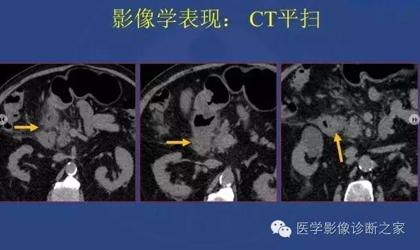 【PPT】沟区胰腺炎CT、MRI及临床相关性